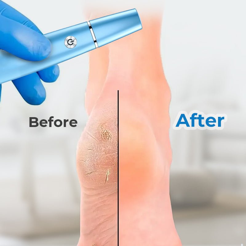 🔥Hot Sale - 50% OFF🔥Electric Feet Callus Remover⚡ - My Good Buys - 🔥Hot Sale - 50% OFF🔥Electric Feet Callus Remover⚡
